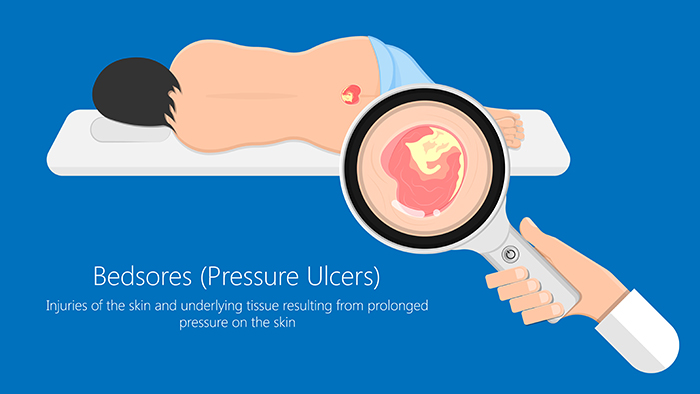 Bedsores - Pressure Ulcers